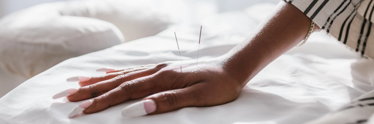 ¿Cómo funciona la acupuntura para reducir la ansiedad?